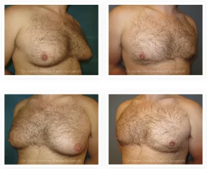 MALE GYNECOMASTIA BEFORE AND AFTER PHOTOS AND GALLERY